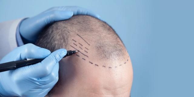 Is a Hair Transplant Worth the Cost? Expert Insights & Real Results
